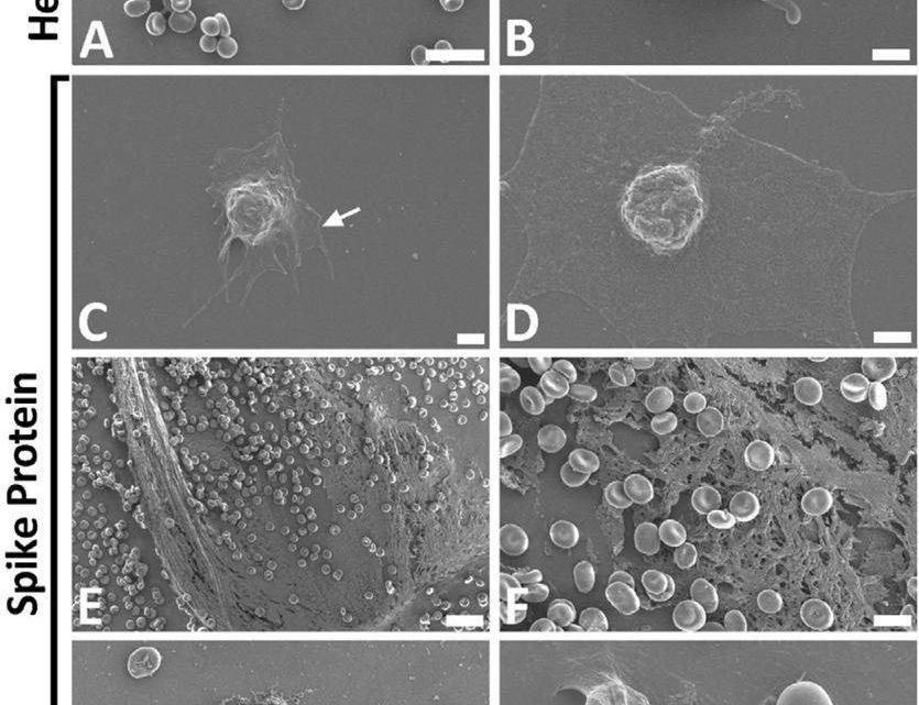 La proteina spike S1, del SARS-CoV-2, induce formazione di fibrinogeno resistente alla fibrinolisi(*): di seguito le implicazioni per la formazione di microcoaguli in COVID-19